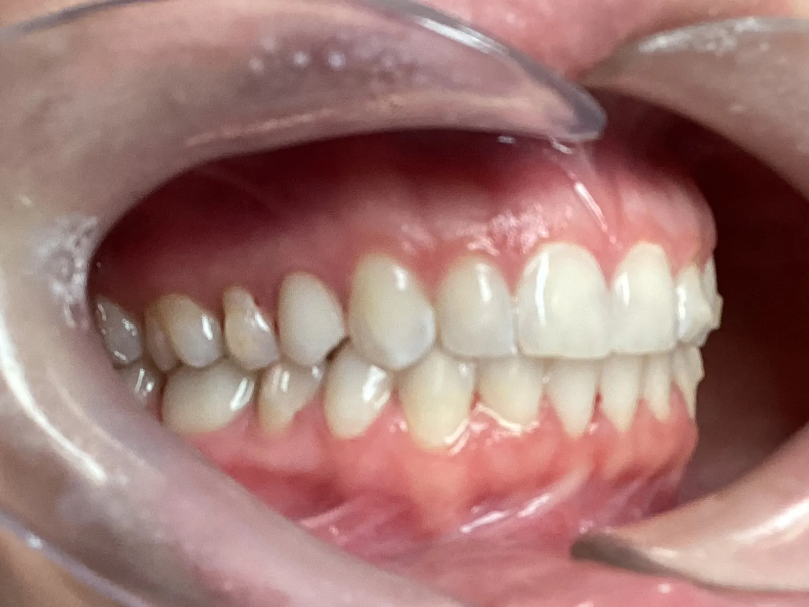After Invisalign Treatment